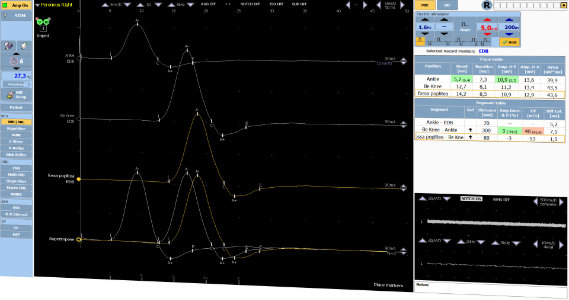TrueTrace NCS Study